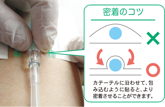 末梢静脈カテーテル固定フィルムのわかりやすい貼り方【エアウォールIV　レギュラータイプ】の画像
