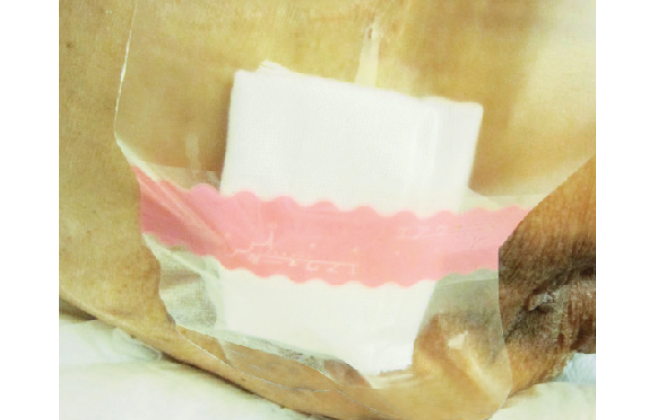 排泄物を入り込ませない！仙骨部（おしり）へのフィルムドレッシングの貼り方の画像