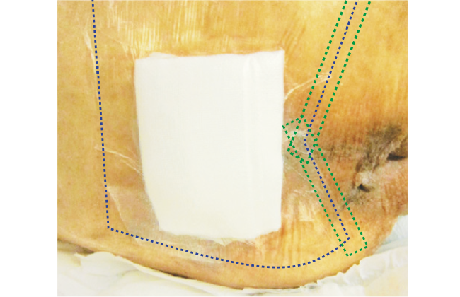 排泄物を入り込ませない！仙骨部（おしり）へのフィルムドレッシングの貼り方の画像
